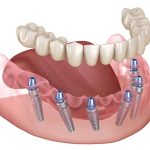 What to Expect During Your Dental Implant Procedure in Manchester