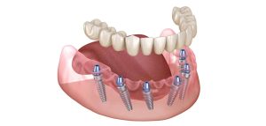 What to Expect During Your Dental Implant Procedure in Manchester