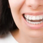 Understanding the Biomechanics of Invisalign for Optimal Smile Design