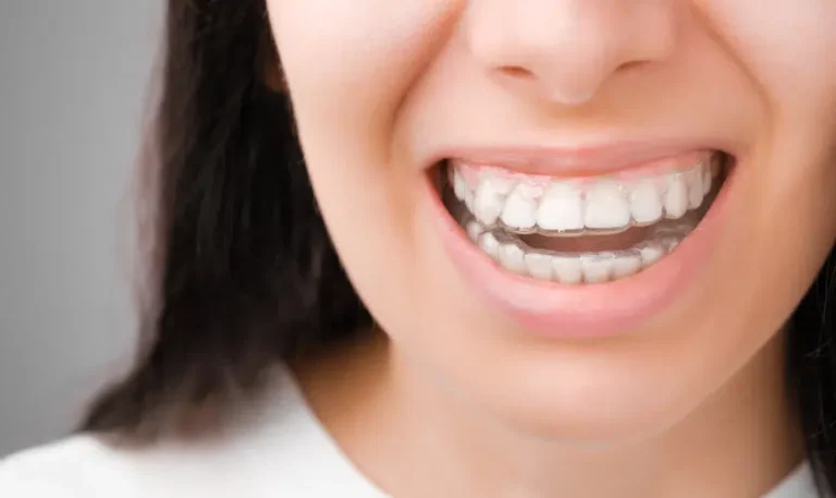 Understanding the Biomechanics of Invisalign for Optimal Smile Design